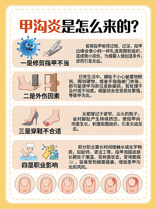 参考原图的医疗科普海报风格，替换内容为甲沟炎是怎么来的科普，标题是甲沟炎是怎么来的？，内容保留：一是修剪指甲不当。若将指甲剪得过短、过深，指甲边缘会像小刺一样扎进周围软组织，造成微小损伤，为细菌入侵创造条件，进而引发炎症。二是外伤因素。日常生活中，脚趾不小心被重物砸到、踢到硬物，或者手指被门夹等，都可能使甲沟部位皮肤破损，若处理不及时或不彻底，细菌就会在受损处繁殖，导致甲沟炎。三是穿鞋不合适。长期穿过于紧窄、尖头的鞋子，会对脚趾产生持续挤压，使指甲向肉里生长，刺激周围组织，引发炎症反应。四是职业影响。部分职业需长时间接触水或化学物质，如厨师、清洁工等，指甲周围皮肤长期处于潮湿、受刺激状态，变得脆弱，容易受到细菌侵袭，增加患甲沟炎的风险。整体为黄色底色白色格纹背景，保留病原体卡通插画风格和皮肤结构示意图位置，医疗科普风格。