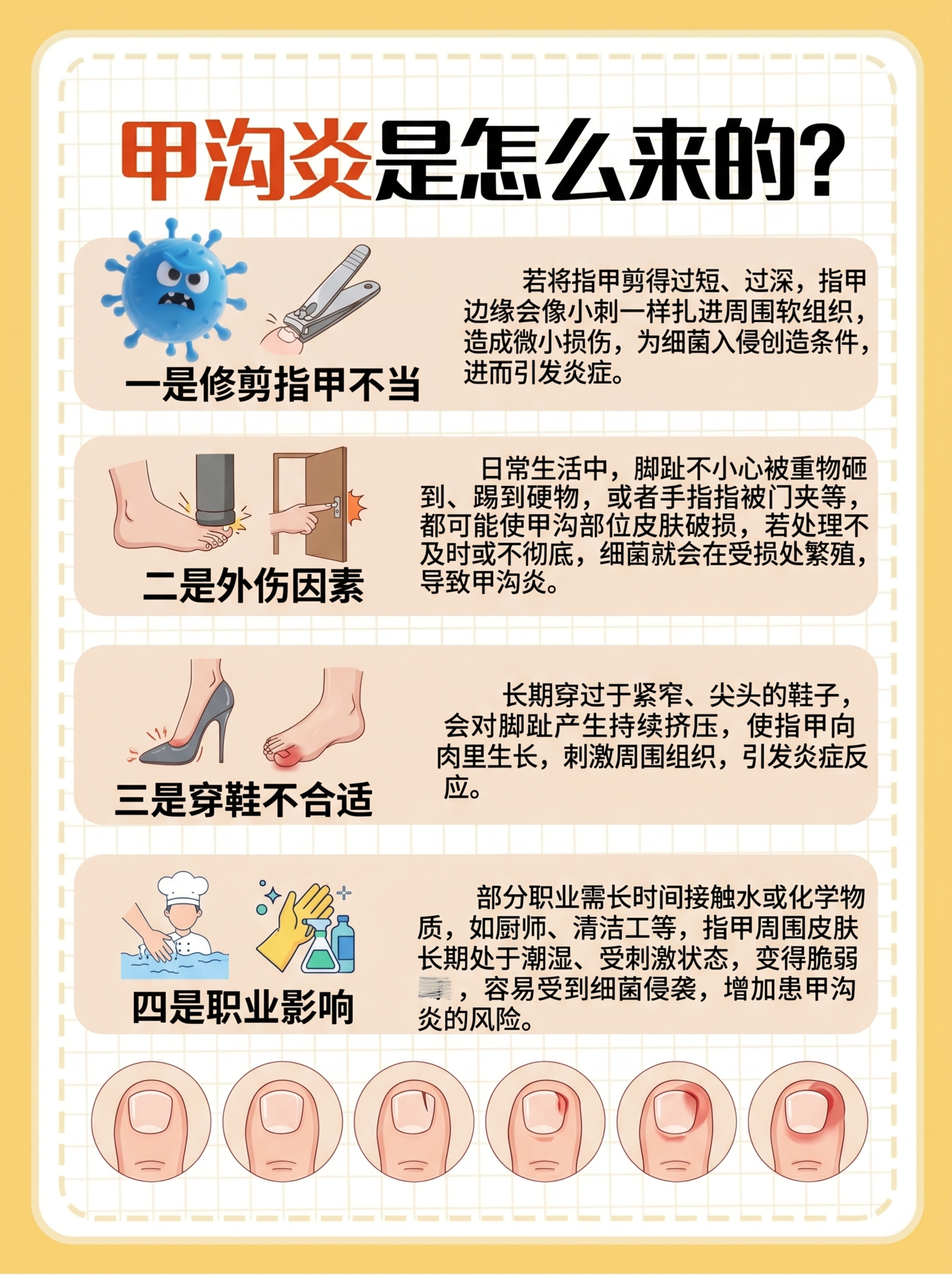 参考原图的医疗科普海报风格，替换内容为甲沟炎是怎么来的科普，标… - 图片创意预览