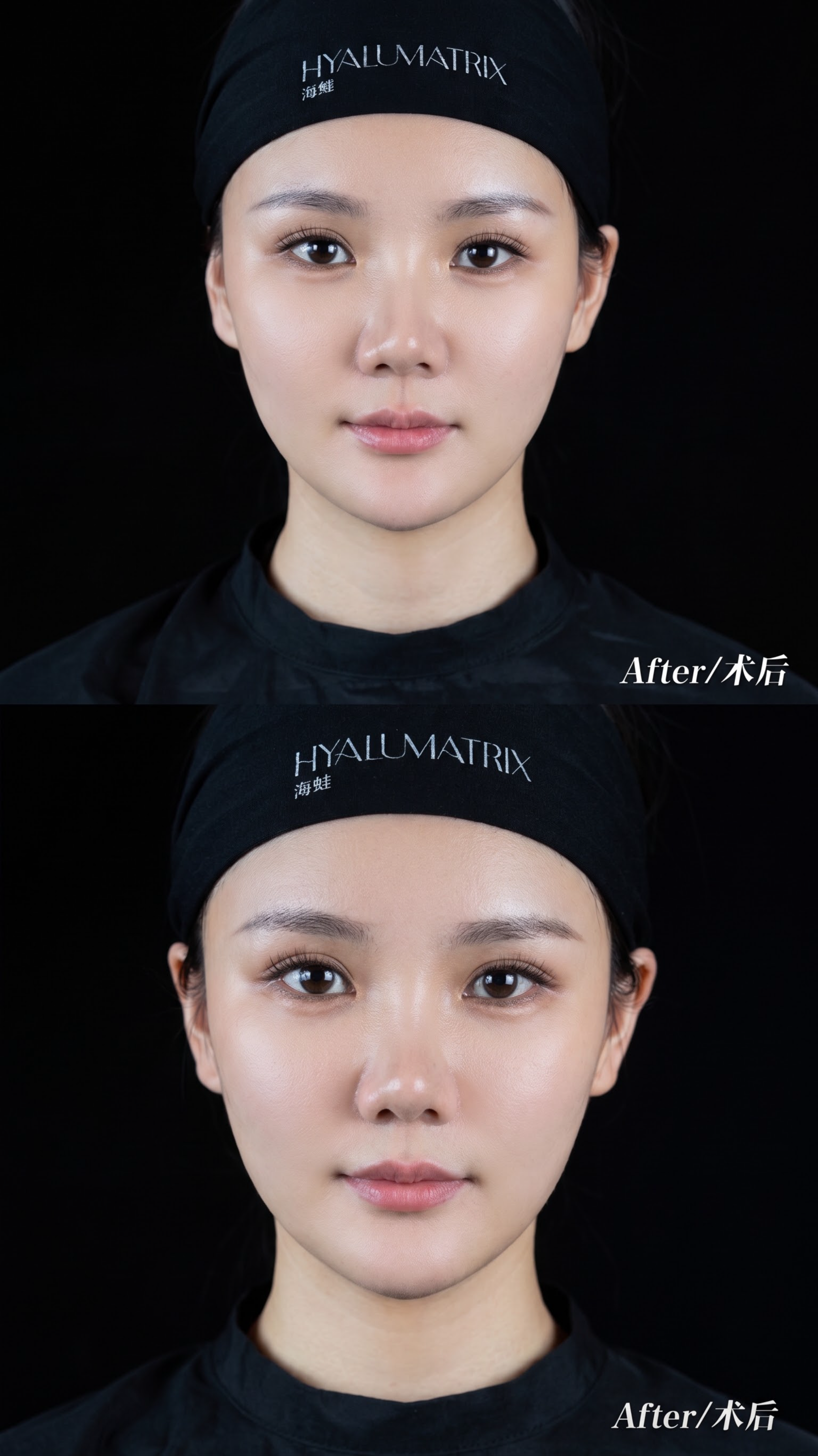 基于参考图中的术后女性人像进行精修美化，保留人物五官特征与发带… - 图片创意预览
