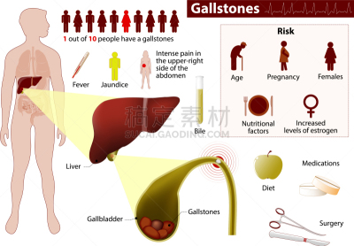 胆石,Lithiasis,健康保健,人,胞囊的,图像,胆汁,胆固醇,生病,瘦身