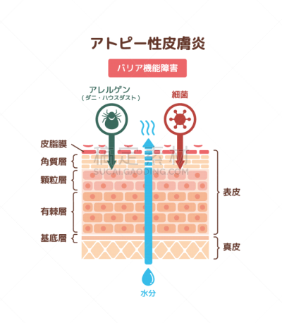 皮炎,矢量,绘画插图,横截面,视角,健康保健,医药职业,背景分离,药,皮肤病学