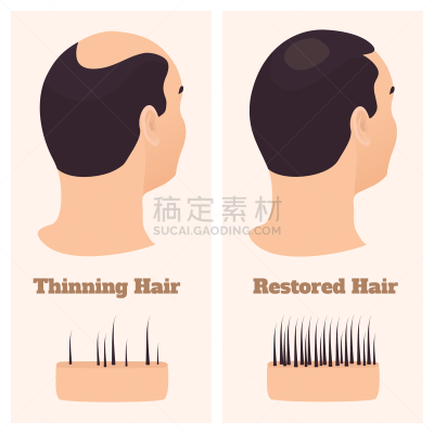 男人,侧面视角,修改系列,毛干,横截面,背景分离,仅男人,医疗流程,仅一个男人,移植手术