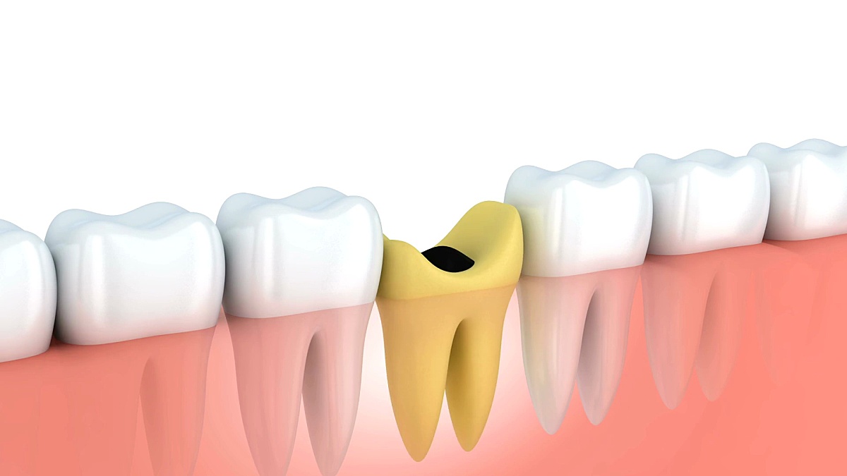 摘要人类牙齿植入。3D渲染