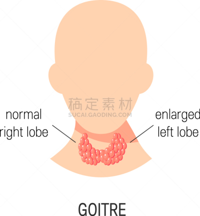 Goiter,白色,健康保健,人,块状,图像,喉咙,生病,教育