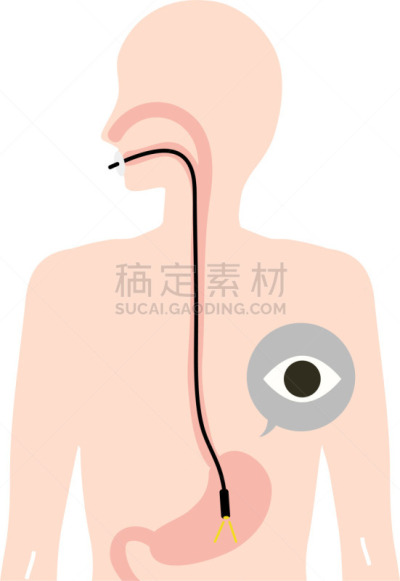 绘画插图,检查,代表,平衡折角灯,粘液,健康保健,背景分离,癌症,粘膜,医疗流程