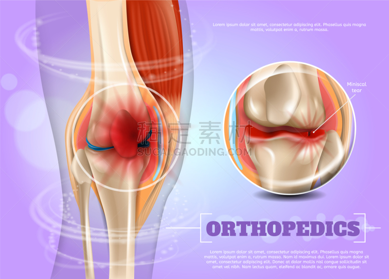健康保健,三维图形,整形器具,半月状软骨,软骨,写实,扭伤,讨论