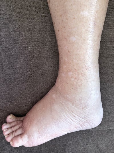 患有水肿病的女性病人的脚