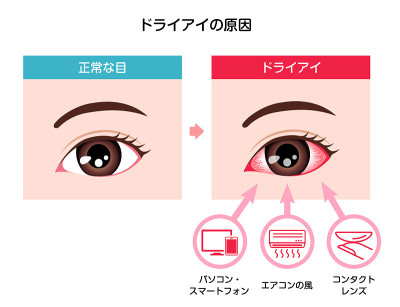 干眼病媒图解的原因(日文)