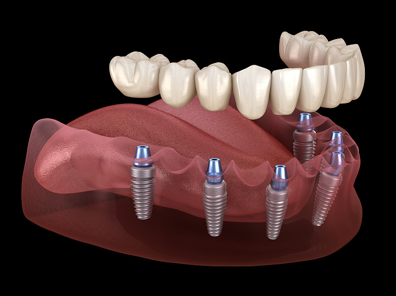 下颌假体全部在6个系统上，由种植体支持。医学上精确的人类牙齿和假牙概念的3D插图