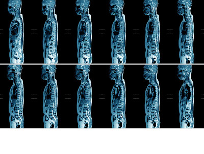 胸腰椎MRI:印象:T11和L2水平中度病理性压迫，T1、T10、t12、L2、L3到L5水平多发性