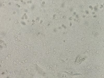 尿镜40x显示大量脓液细胞，少量上皮细胞。显微照片