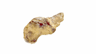 胰腺炎疾病的人胰腺孤立的白色。三维演示