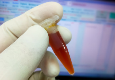 科学家手持埃彭多夫黄疸血清实验室检测。高胆红素血