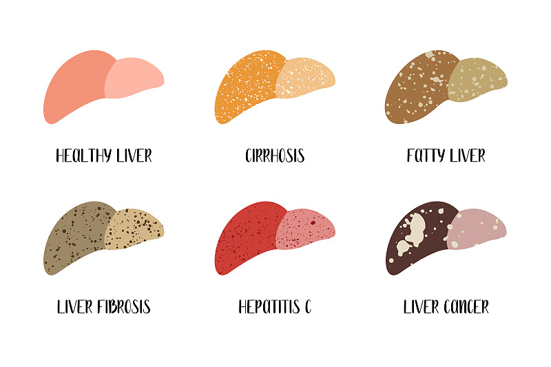 肝脏健康，各种肝脏疾病。肝脏病学。肝脏损伤的阶段。肝硬化，脂肪肝，纤维化，丙型肝炎，癌症。矢量平面插