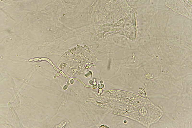 患者尿液中的假菌丝和芽殖酵母细胞