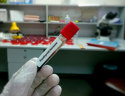 科学家或生物化学家持有样本进行甲状旁腺素(PTH)测试，诊断器官疾病。