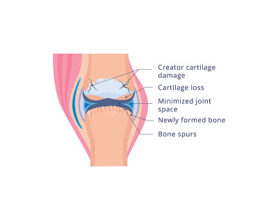 Knee joint damage with osteoarthritis, flat vector