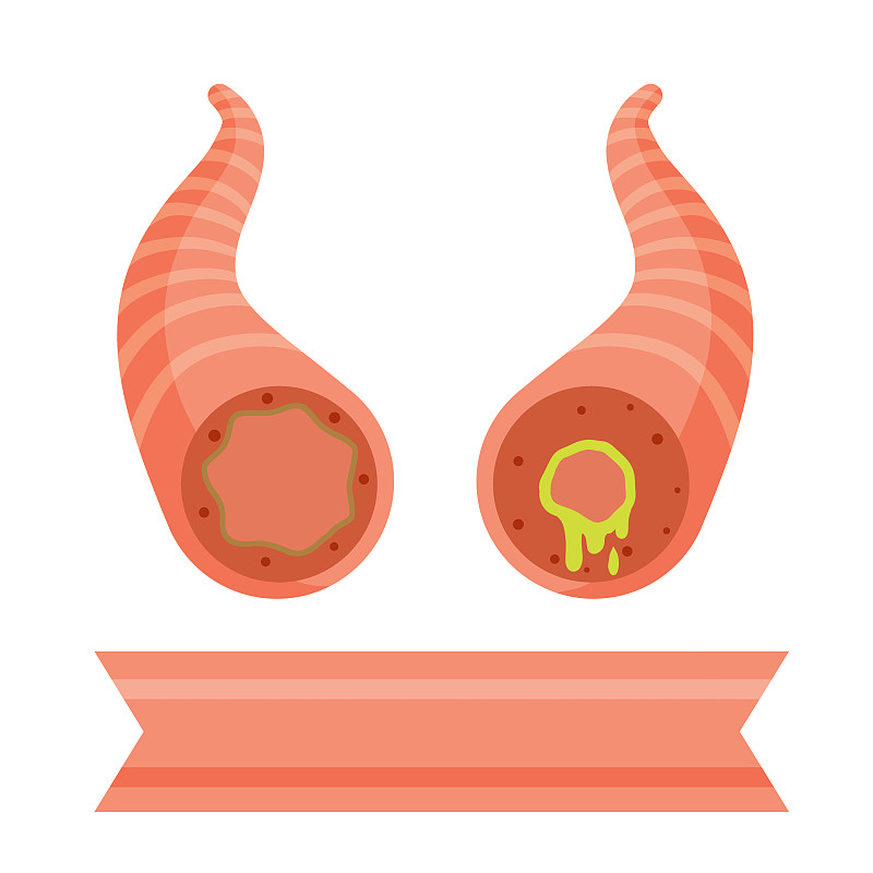 哮喘。医疗方案。引起呼吸急促和咳嗽。健康和生病的管状粘液。呼吸道疾病。损伤气管