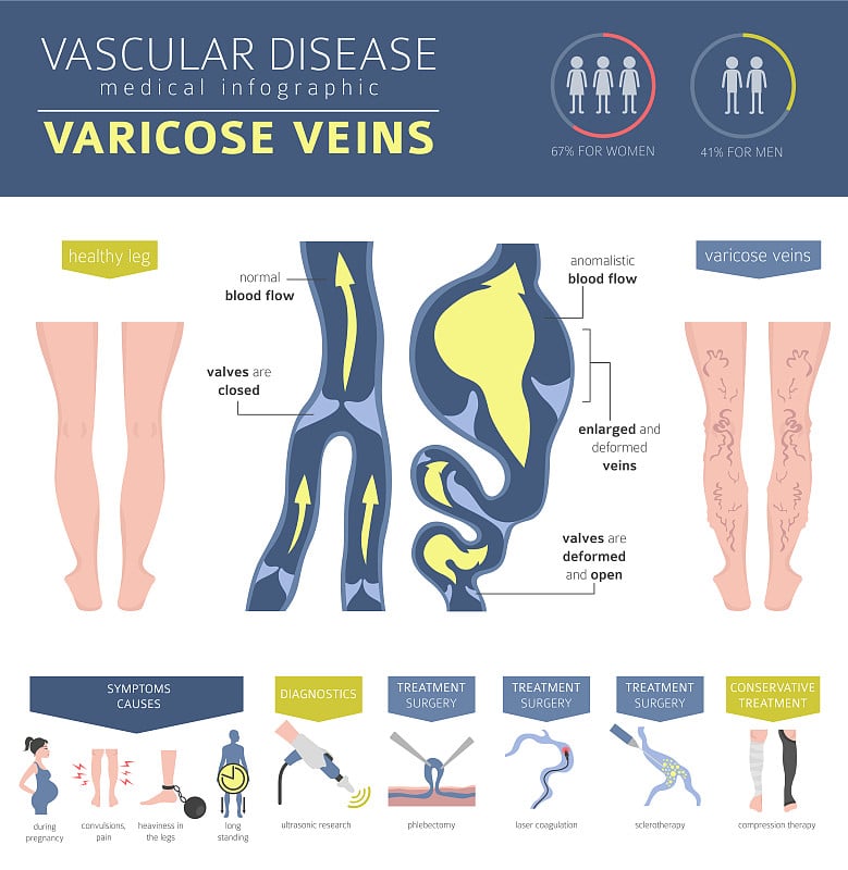 血管疾病。静脉曲张症状，治疗图标设置。医疗信息图表设计