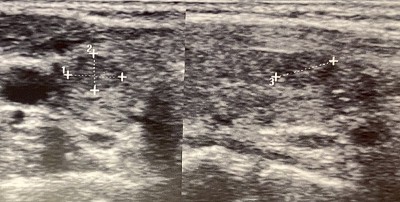 甲状腺结节超声检查
