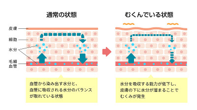 正常皮肤与肿胀皮肤对比图(日文/附说明文字)