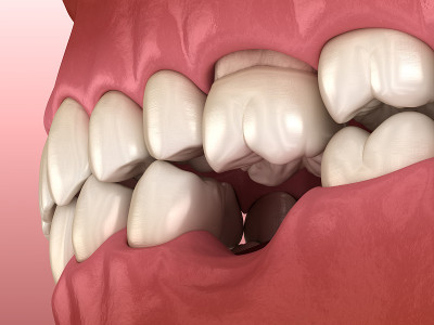 失臼齿后牙齿移位变形。Popov Godon现象的3D插图