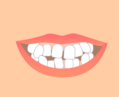 矫正前后牙齿