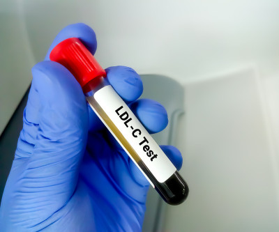 血液样本进行LDL-C(低密度脂蛋白)检测。血脂。坏胆固醇。