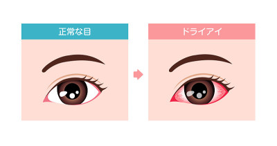 Comparison illustration between normal and dry eye