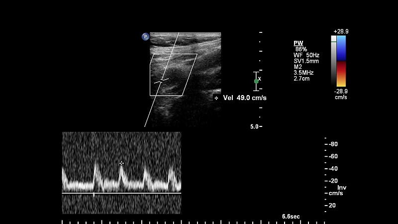 血管超声检查。
