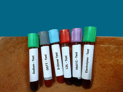 血液样本用于各种医学测试LDL, OGTT, HbA1C，电解质，钠和d -二聚体检测。医疗试管。