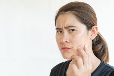 亚洲妇女有问题的痤疮在她的脸上发炎。