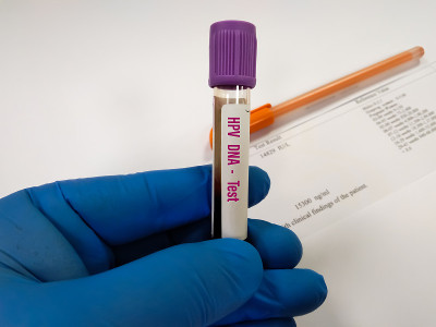 在医学实验室进行HPV DNA测试