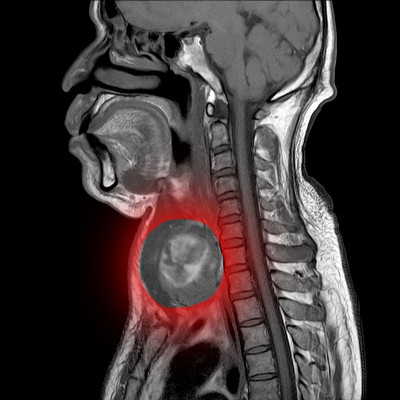颈部磁共振成像(MRI)，矢状面，颈部印模1例:-甲状腺Lt叶下极咽后间隙囊肿深部感染