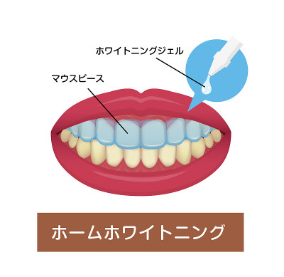 在家美白牙齿矢量图(日语)