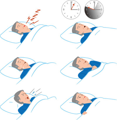 患有睡眠呼吸暂停综合症的老年人。睡眠呼吸暂停