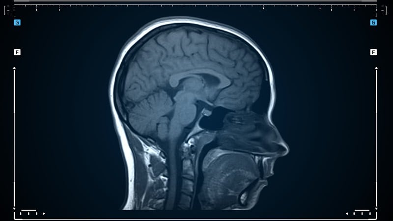 对运动中的人脑进行核磁共振扫描。脑部磁共振成像扫描。医疗诊断工具。