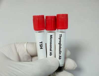 实验室甲状腺激素检查用试管血样。抗微粒体，抗甲状腺球蛋白，促甲状腺激素。甲状腺癌的诊断