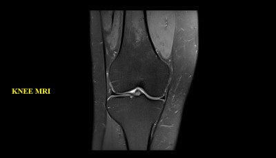 膝关节MRI(磁共振成像)