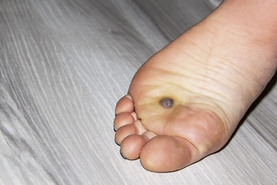 女性腿部与黑暗的空间在脚后氮冷冻足底疣后三周