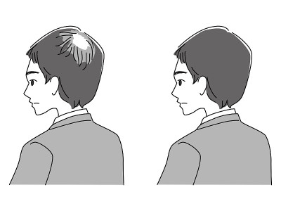 前后都是头发稀疏的男人。单色插图。