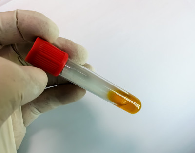 技师戴着手套手持高胆红素血清样本，用于诊断黄疸病。