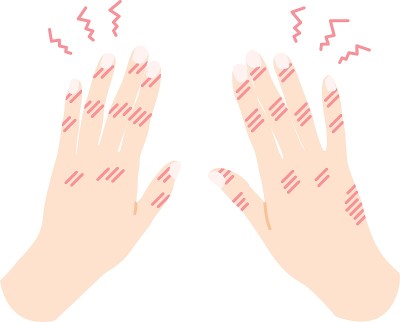 手和手指冻疮插图