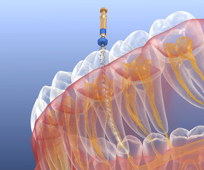 根管治疗过程。医学上准确的牙齿3D插图。