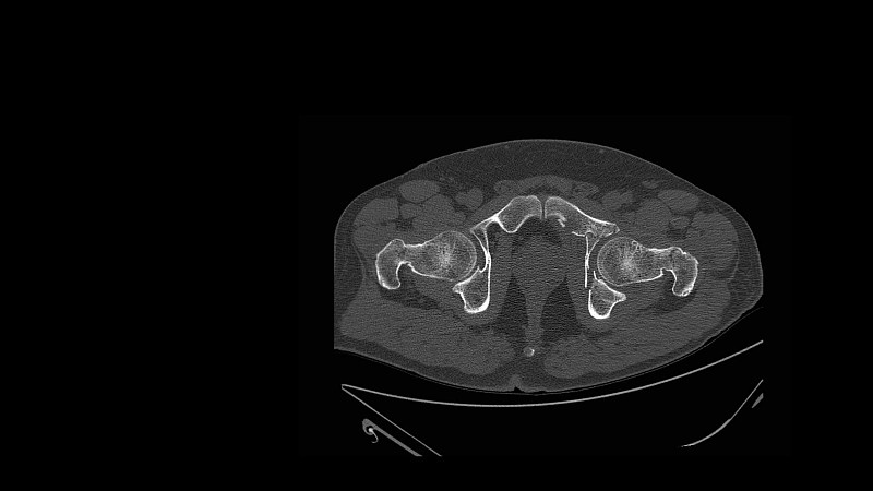 髋部x线CT扫描显示髋部骨折或髋臼骨折(髋臼骨折病)。交通事故中病人受伤。骨科创伤与医学调查技术概念