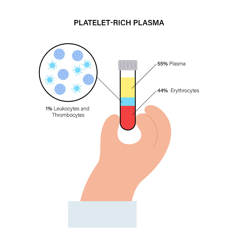富血小板血浆概念