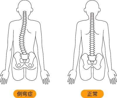 这是脊柱侧弯时身体扭曲的图示。(日本人是脊柱侧弯/正常)