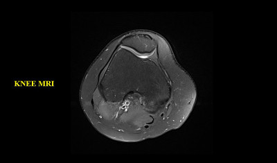 膝关节MRI(磁共振成像)