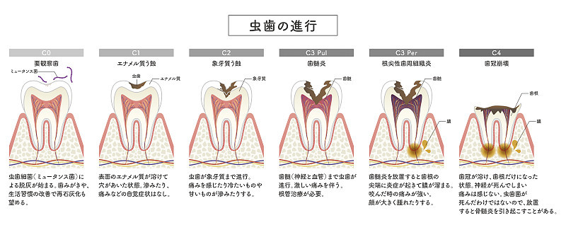 蛀牙进展的图解