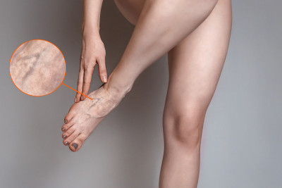 一位年轻女子因血管疲劳和疼痛而按摩她的腿。静脉曲张的概念。放大在一个单一的图像